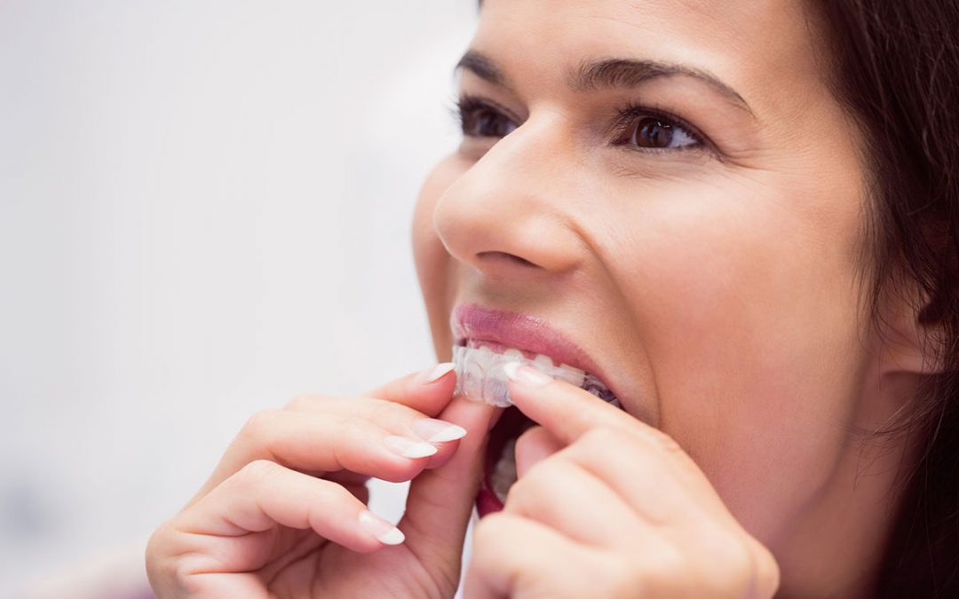 ¿En qué consiste la ortodoncia invisible Invisalign?